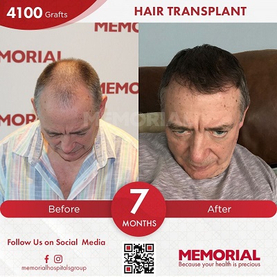 hair transplant