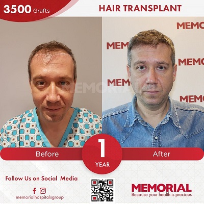 hair transplant