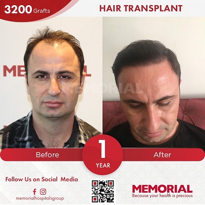 hair transplant