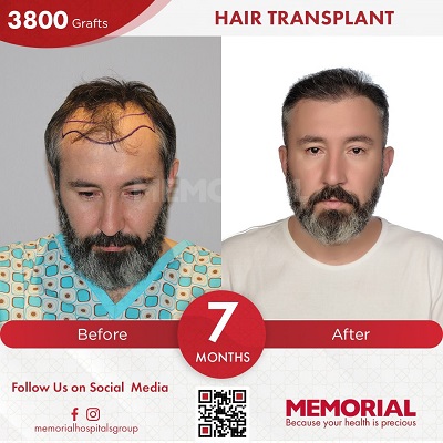 hair transplant