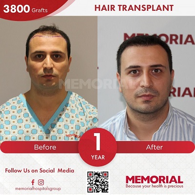 hair transplant