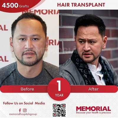 hair transplant